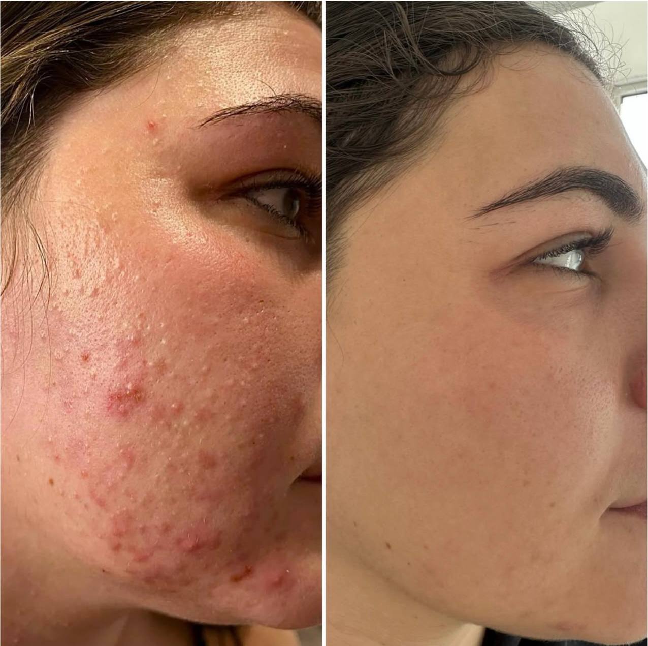 Before and after advanced facial treatment results — acne-prone skin improvement