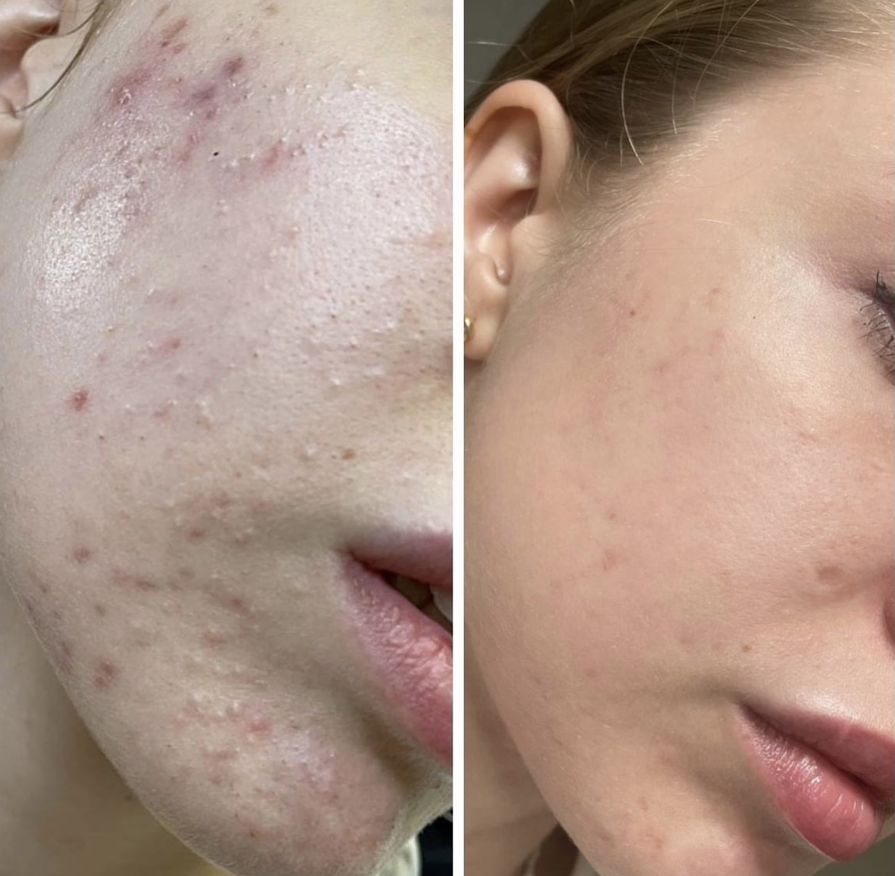 Combined results of advanced facial treatments and professional home care